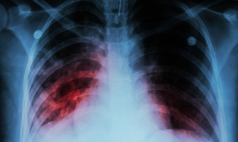 Secretaria de Saúde alerta para aumento de casos de tuberculose em Linhares